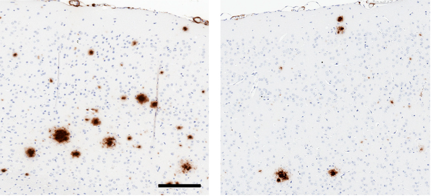 Research reveals a potential new biotherapy for Alzheimer’s disease